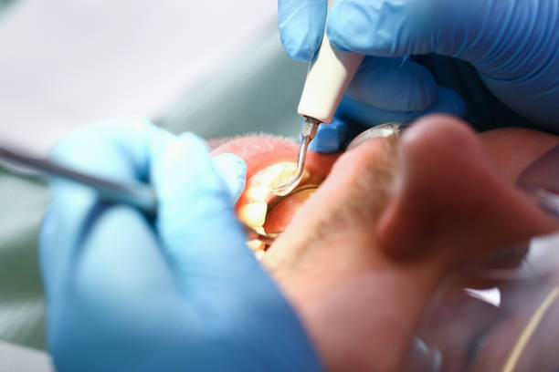 Best Emergency Treatment for Dental Infections or Abscesses in Newport Beach, CA